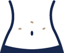 트로카 수술 시진